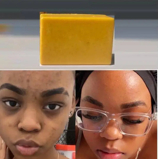 Turmeric Kojic Acid Soap ( Glow’N Bar Soap)